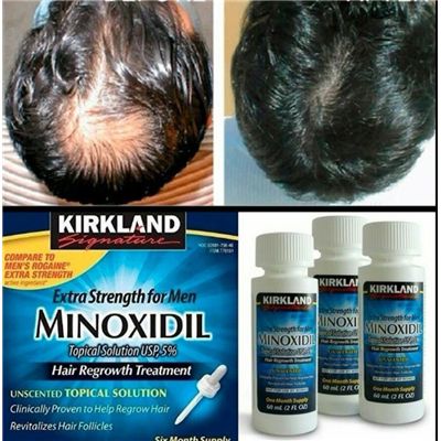 Minoxidil 5% Extra Strength