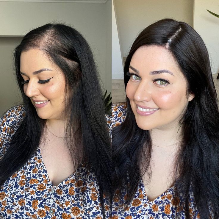 Minoxidil 5% Extra Strength